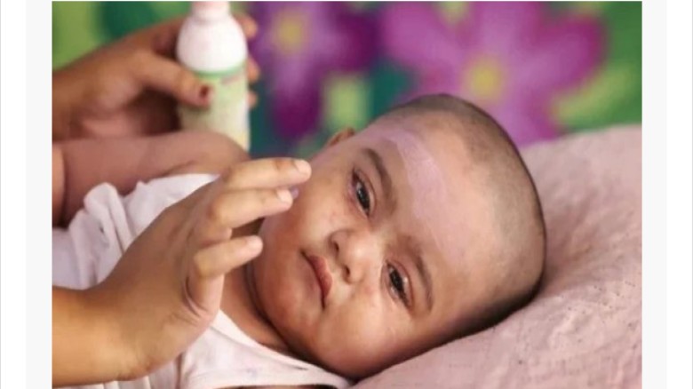 হাম ও হামের উপসর্গে ১২ শিশুর মৃত্যু, চট্টগ্রামে মৃত্যু নেই